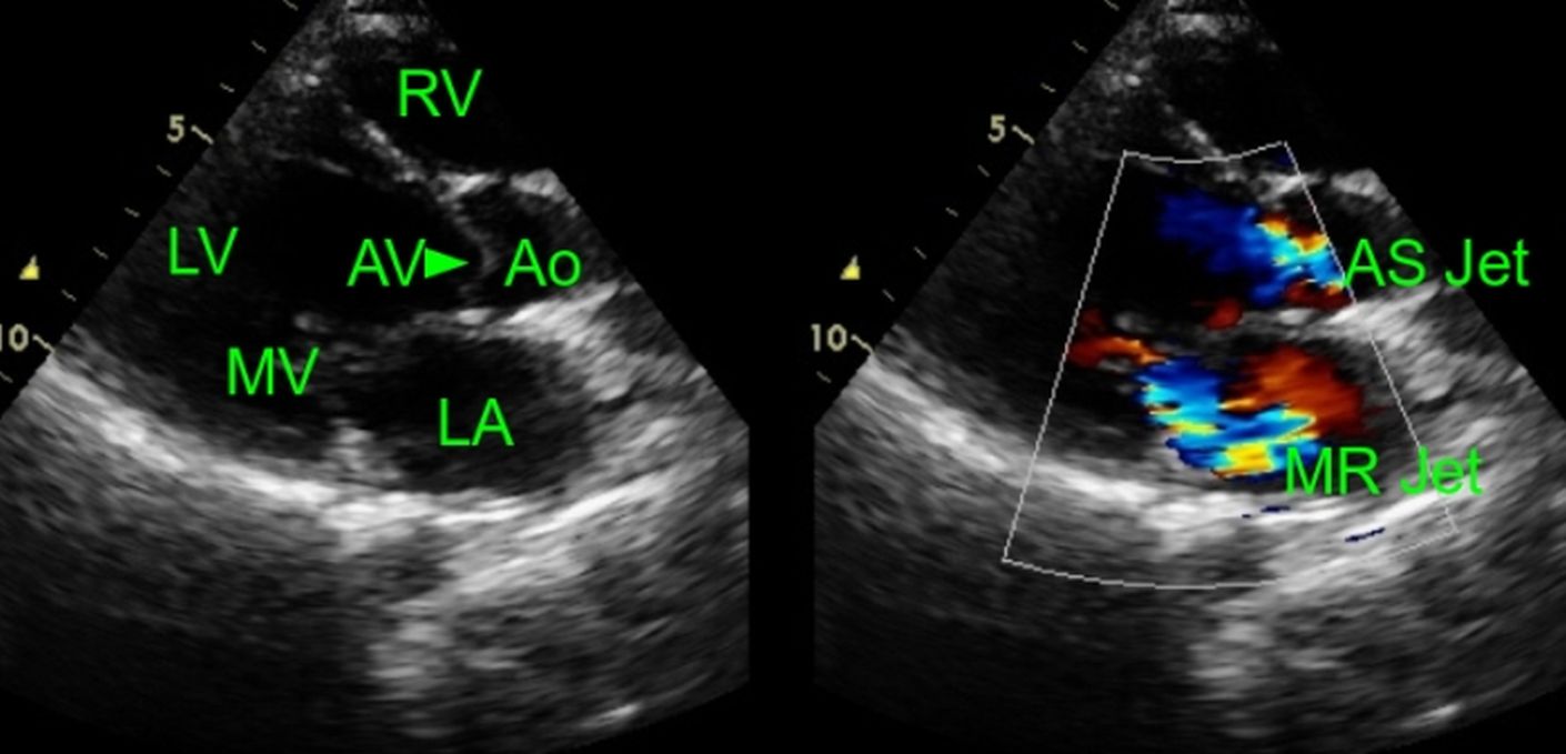 Mitral regurgitation with aortic stenosis