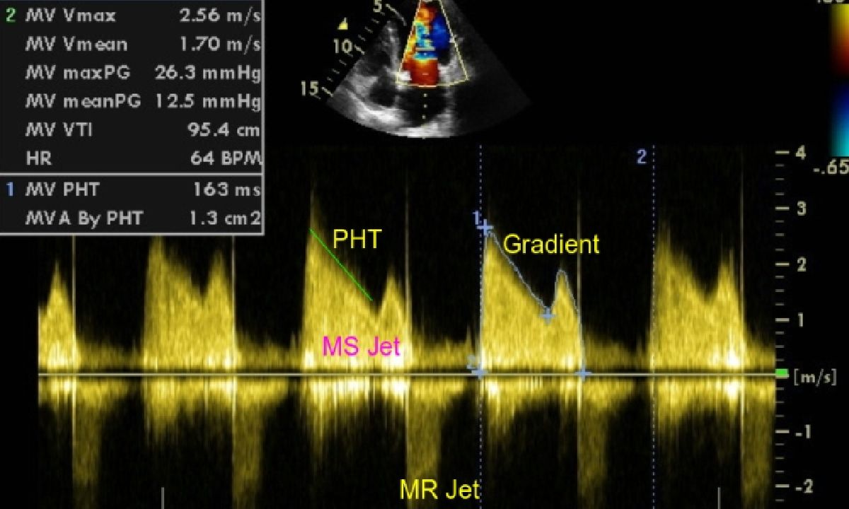 Doppler in mitral stenosis and regurgitation