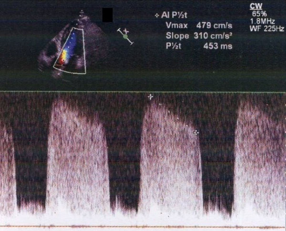 Pressure half time in aortic regurgitation