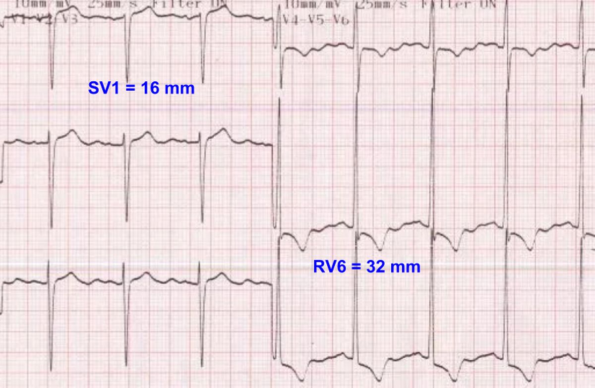 Sokolow Lyon criteria for LVH