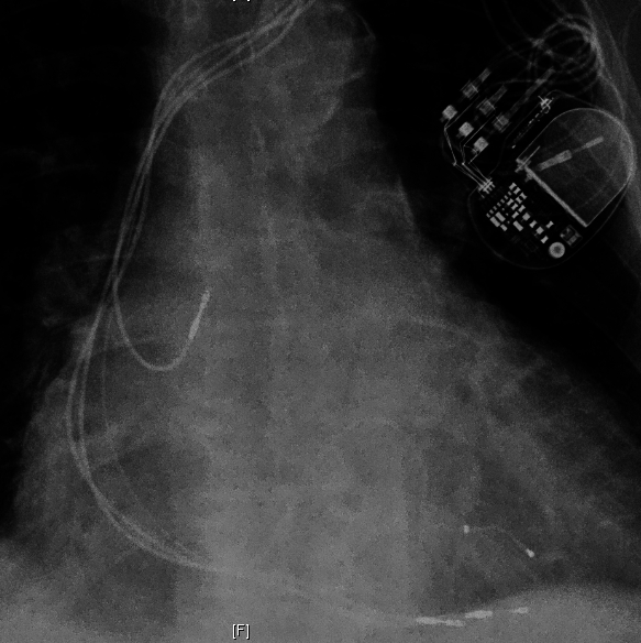 Penetrated view of X-ray chest in CRT showing LV, RV and RA leads