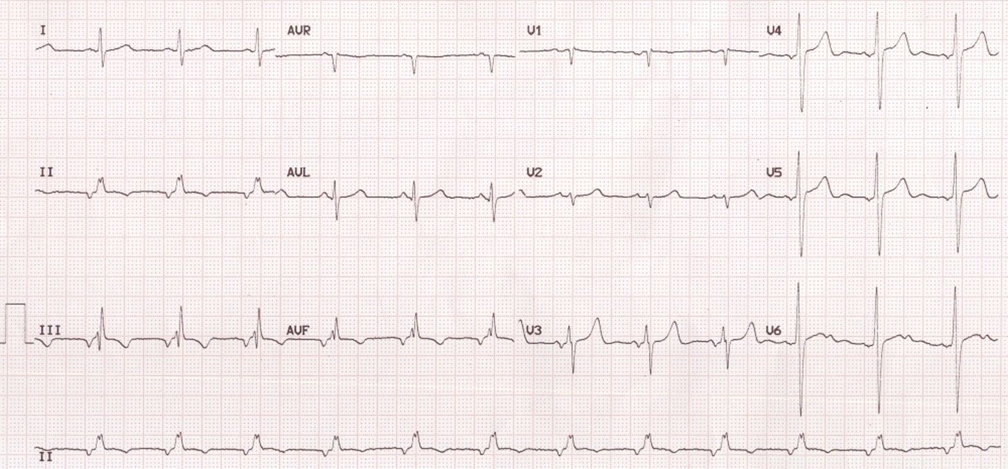 ECG showing inverted P waves in inferior leads