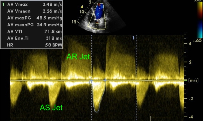 Aortic stenosis gradient