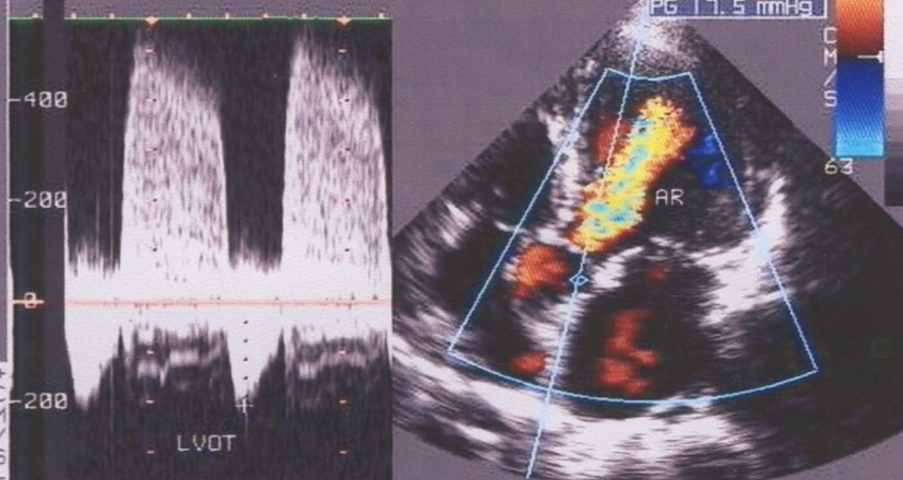 Aortic Regurgitation CW and Colour Doppler