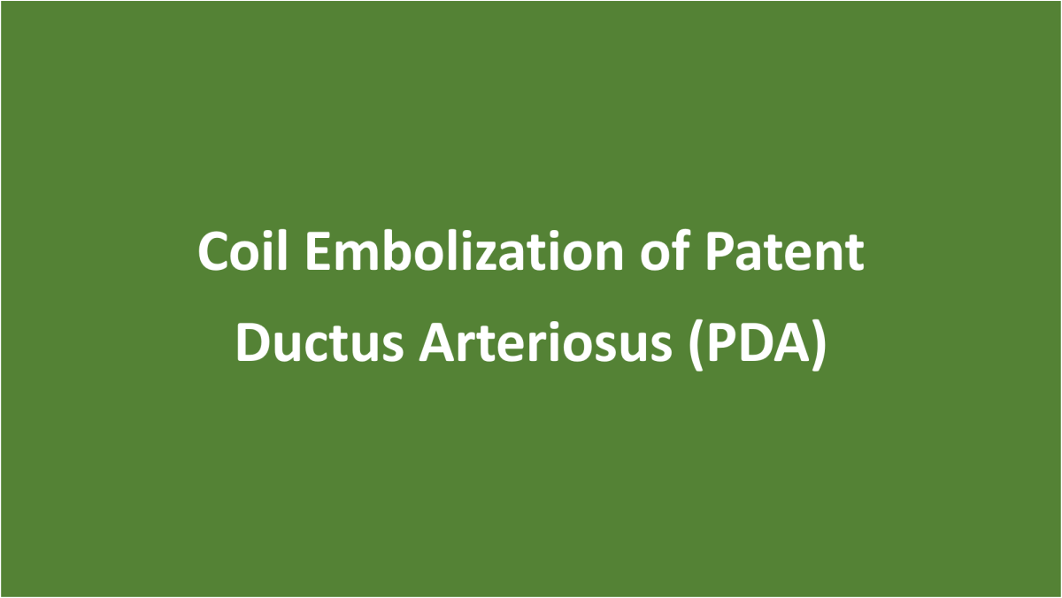 Coil Embolization of Patent Ductus Arteriosus (PDA)