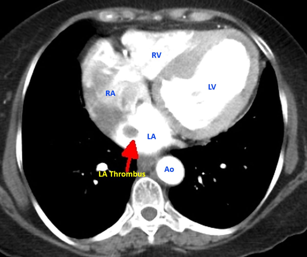 Left atrial thrombus - Contrast CT Scan