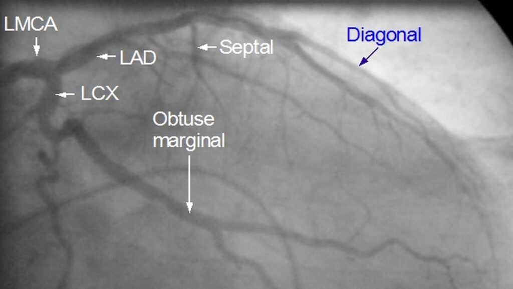 Left coronary artery angiogram