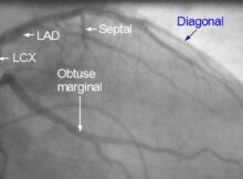 Left coronary artery angiogram