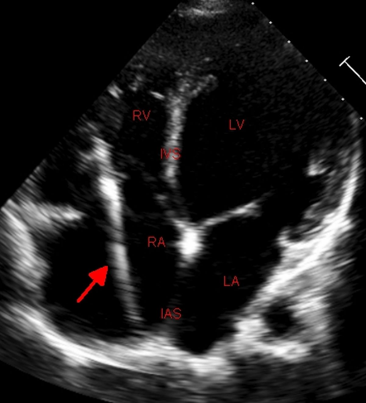 Pacemaker lead on echocardiogram