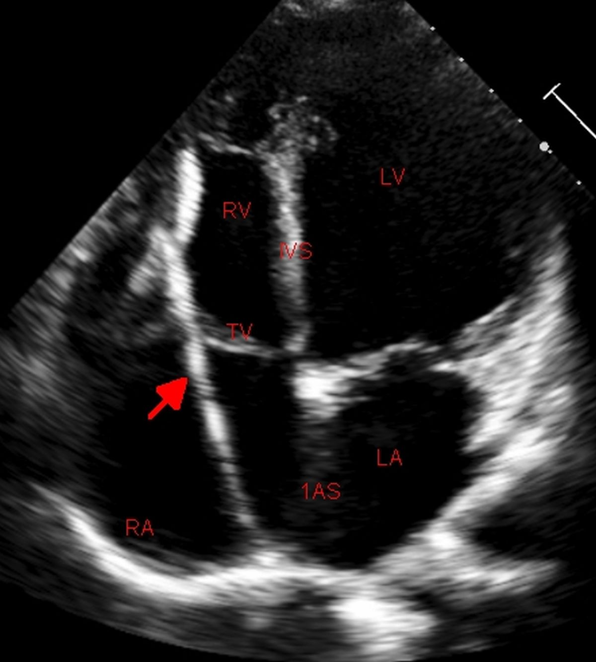 Pacemaker lead on echocardiogram