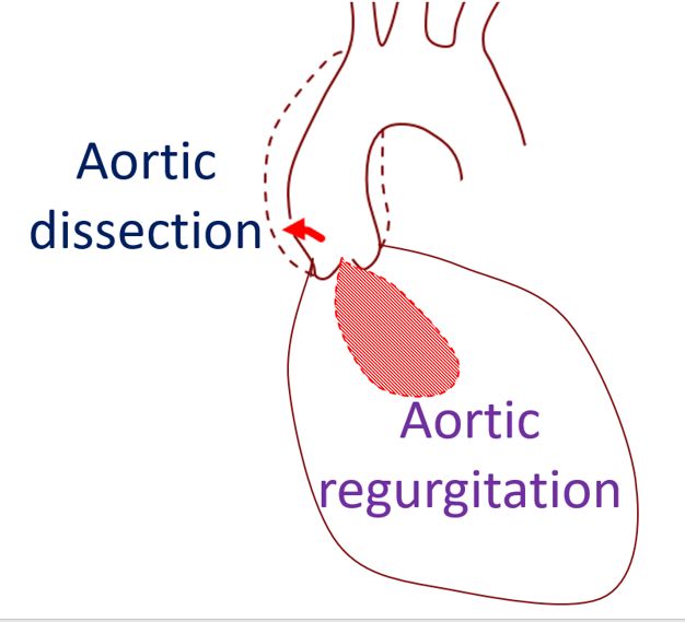 Aortic regurgitation in aortic dissection (Diagrammatic representation)