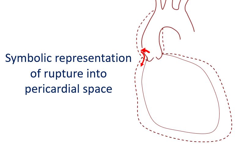 Symbolic representation of rupture into pericardial space