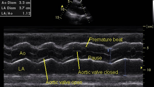 Symmetric closure line of trileaflet aortic valve