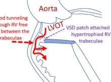 Blood tunneling through RV free wall between the trabeculae in intramural VSD