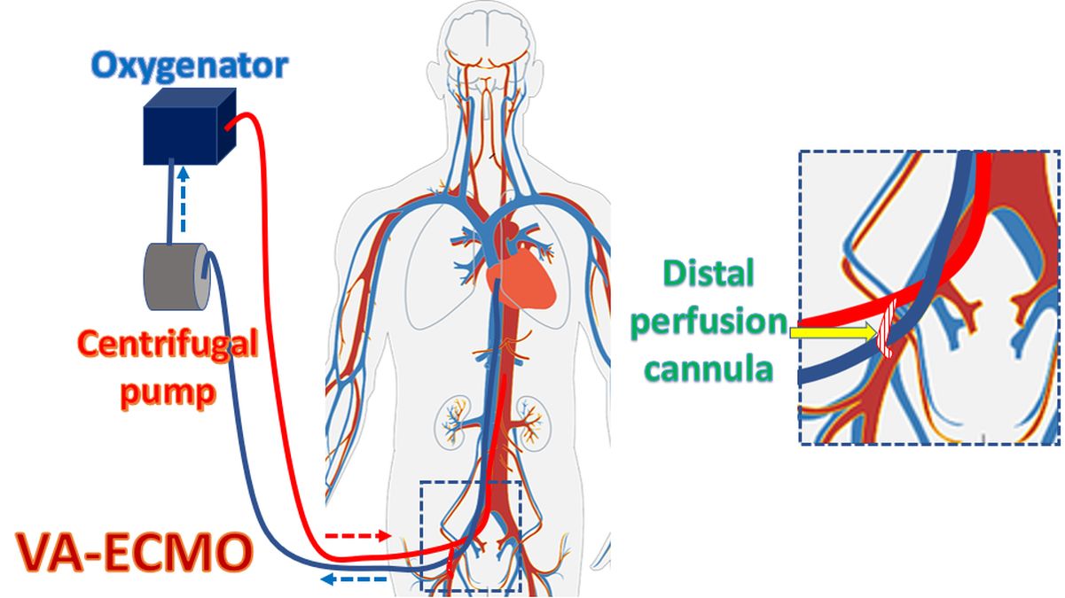 Distal perfusion cannula to prevent limb ischemia in venoarterial ECMO