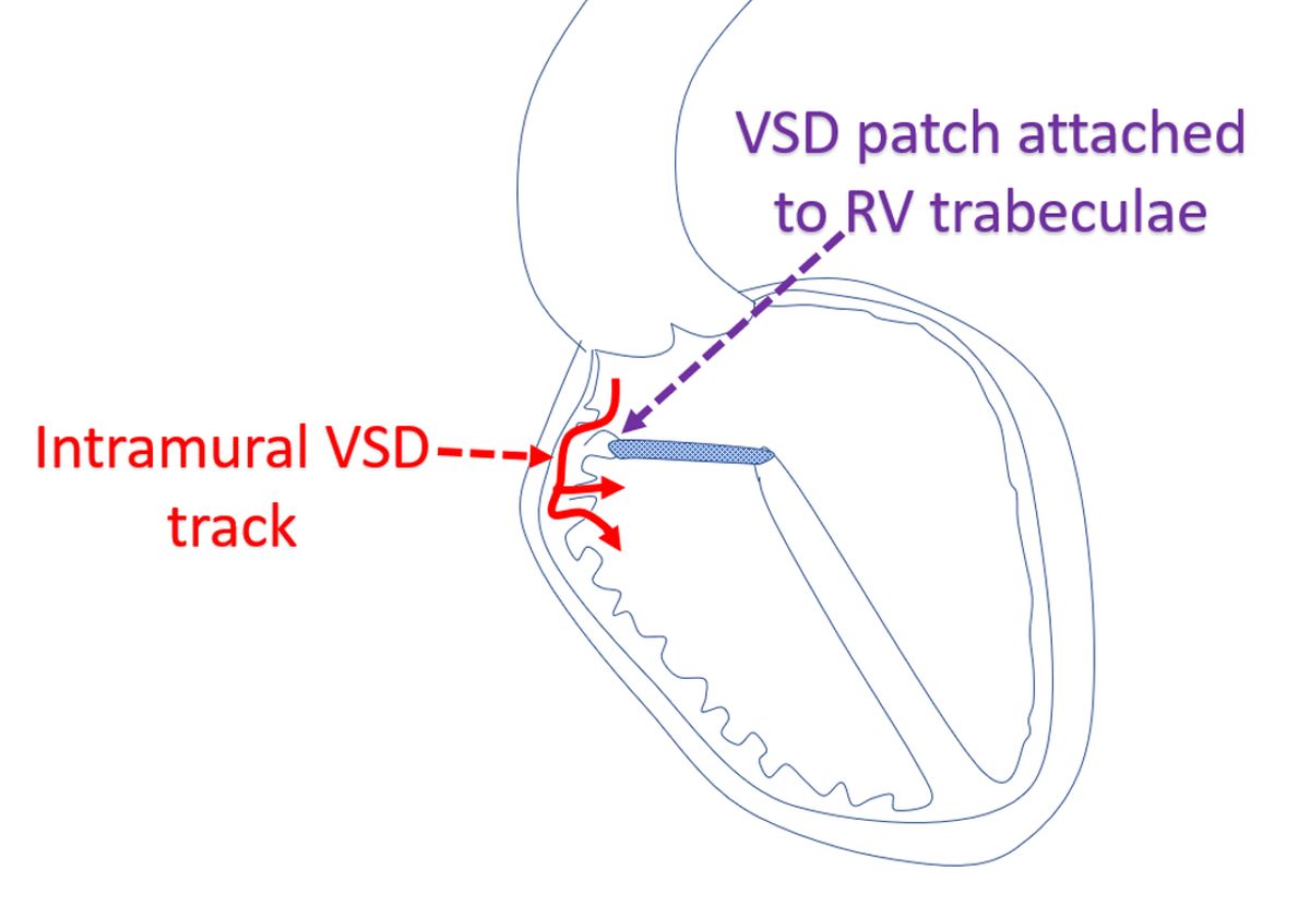 Intramural VSD after repair of conotruncal anomalies