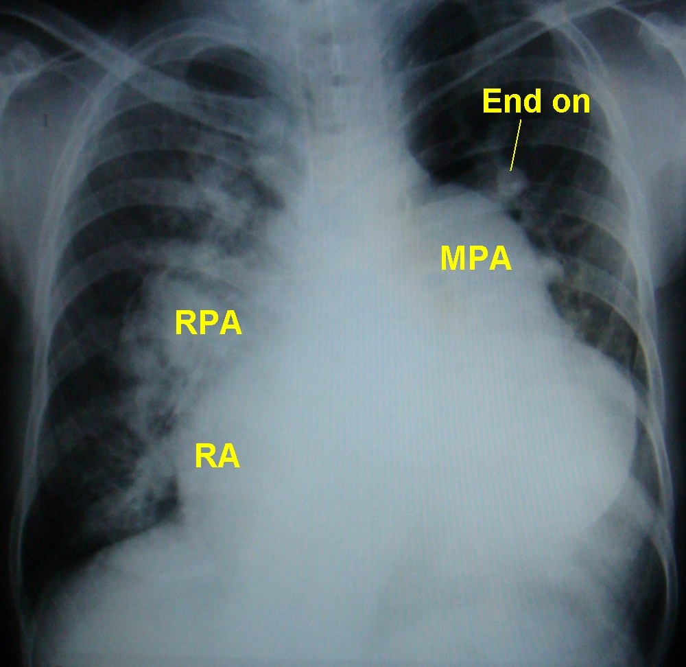 X-ray chest PA view in atrial septal defect with pulmonary hypertension