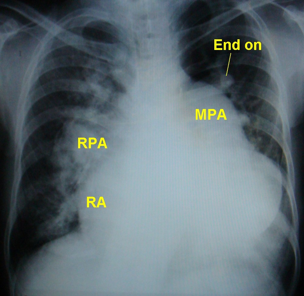 What is crochetage sign in atrial septal defect? 