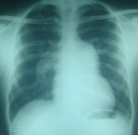 X-ray chest PA view in atrial septal defect with severe pulmonary hypertension