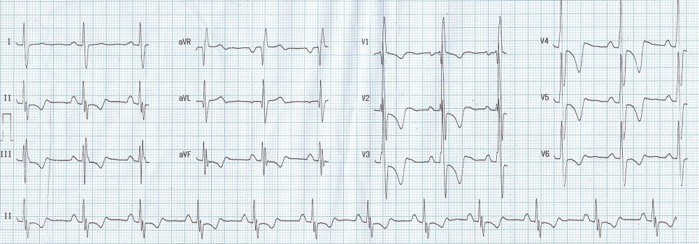 ECG in atrial septal defect with severe pulmonary hypertension