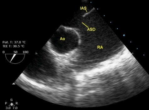 Atrial septal defect on transesophageal echocardiography