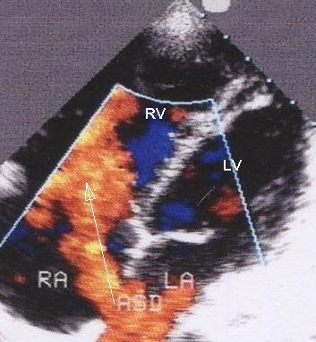 ASD flow by colour Doppler