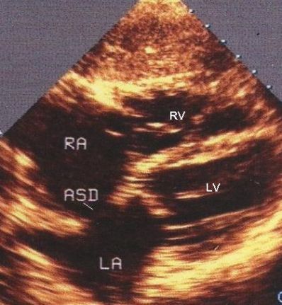 ASD on 2D echo