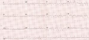 Anterior wall myocardial infarction (AWMI) with RBBB and AF
