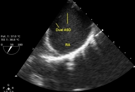 Two atrial septal defects with a small segment of intervening septum