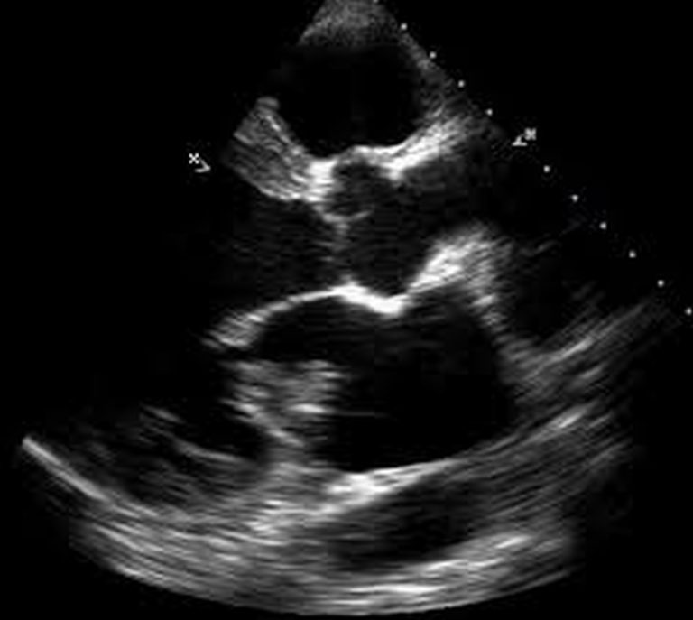 Left Atrial Myxoma – Echocardiogram In Parasternal Long Axis View