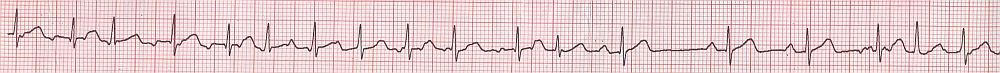 Multifocal atrial tachycardia