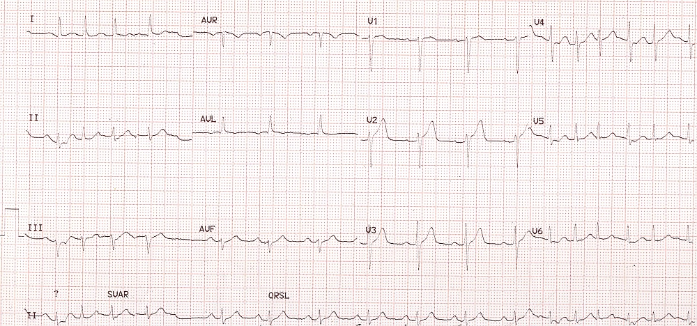 ectopic atrial tach