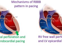 Mechanisms of RBBB pattern in pacing