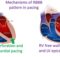 Mechanisms of RBBB pattern in pacing