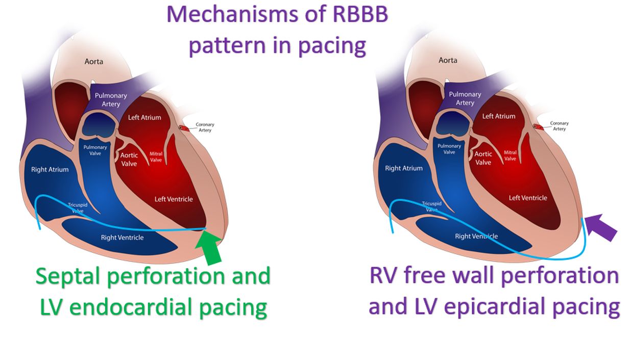 Mechanisms of RBBB pattern in pacing