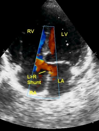 Colour Doppler echocardiogram showing left to right shunt in ostium primum ASD