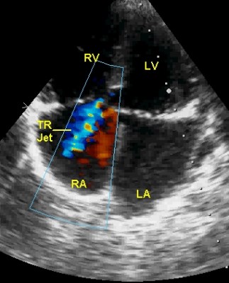 Apical four chamber view showing tricuspid regurgitation in primum ASD