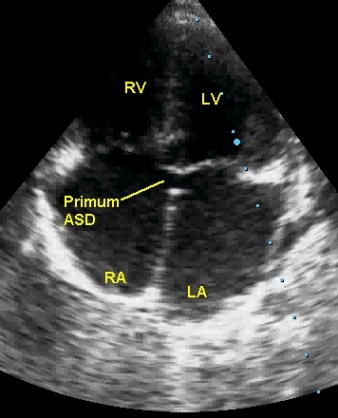 Echocardiogram in apical four chamber view of primum ASD