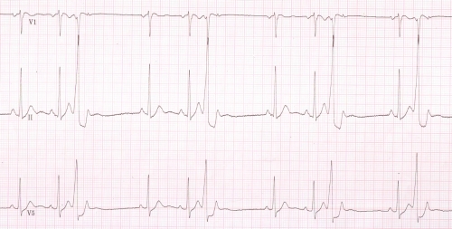 R on T ventricular premature complexes in recovery