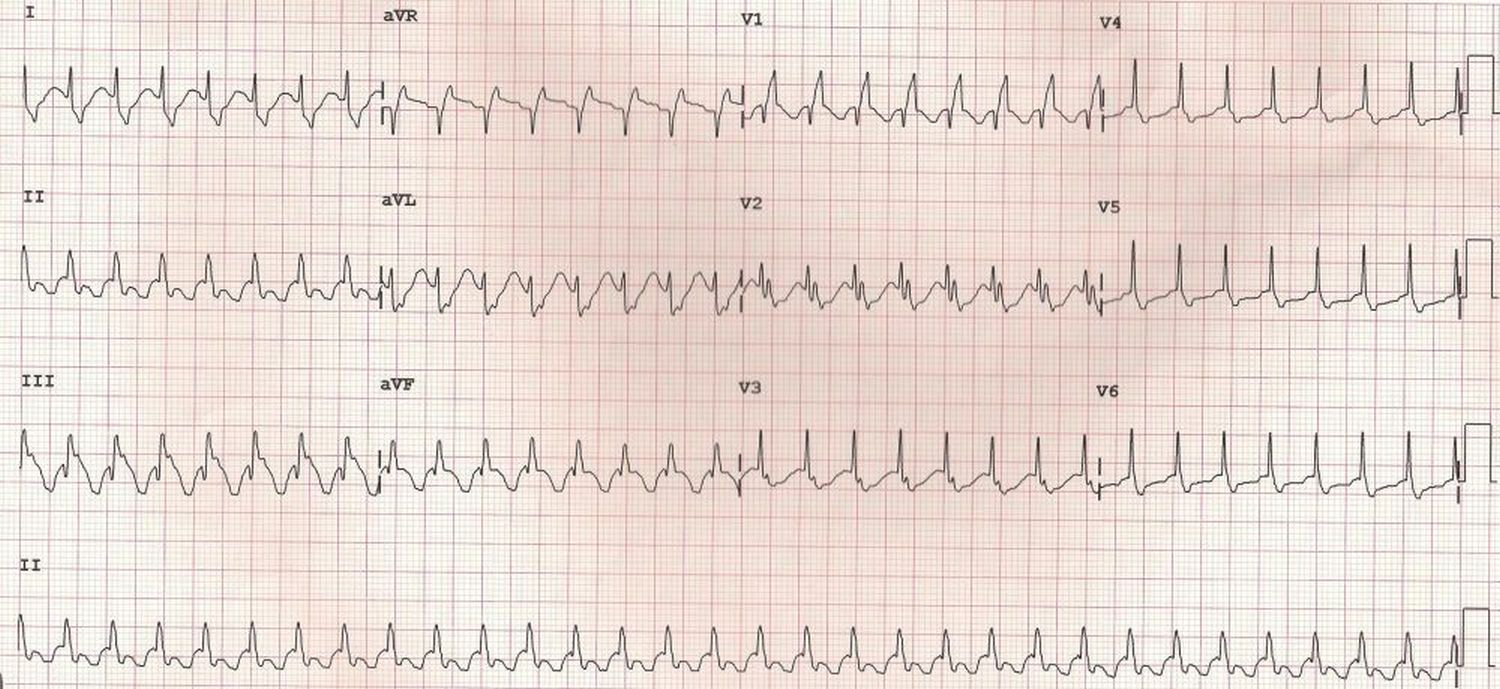 SVT with RBBB (Supraventricular tachycardia with RBBB)