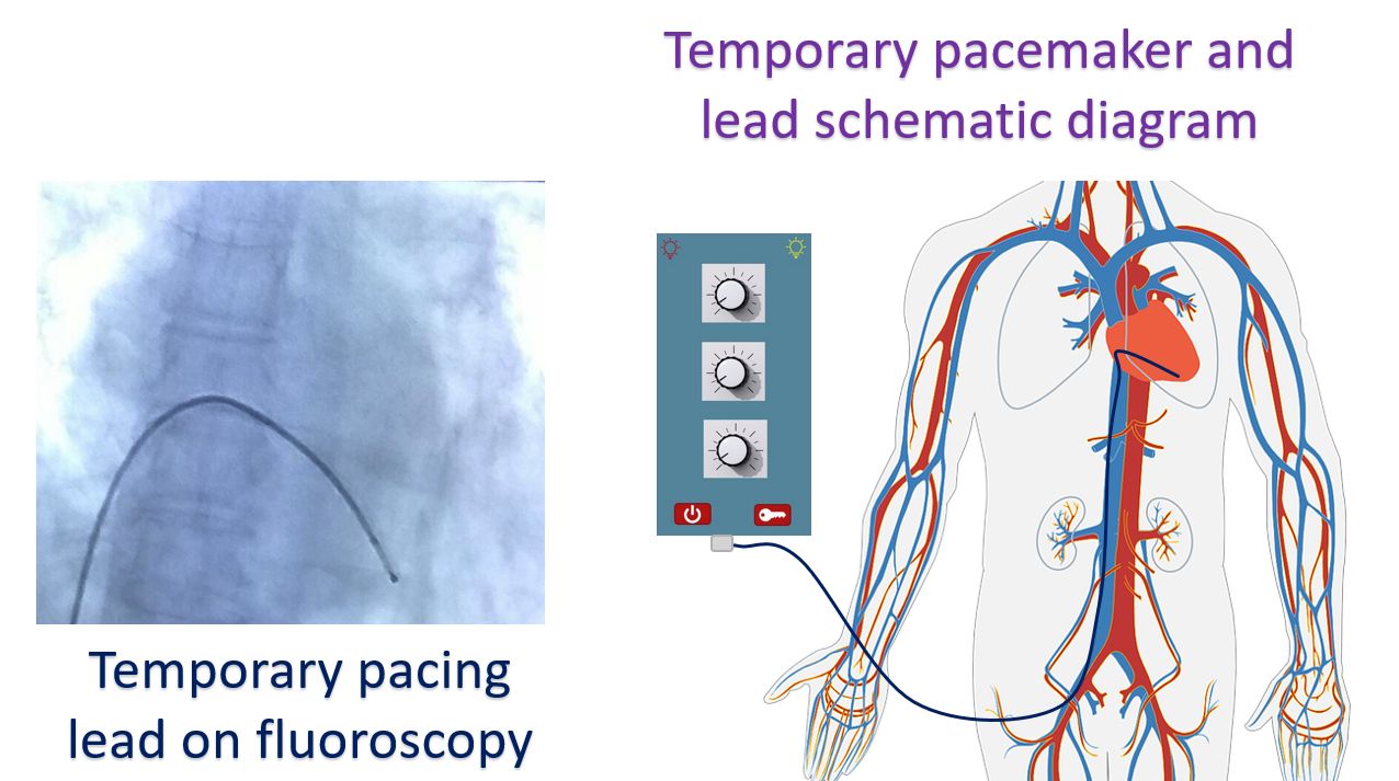 Temporary Pacing Ecg All About Cardiovascular System And Disorders 