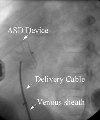 Device closure of ASD