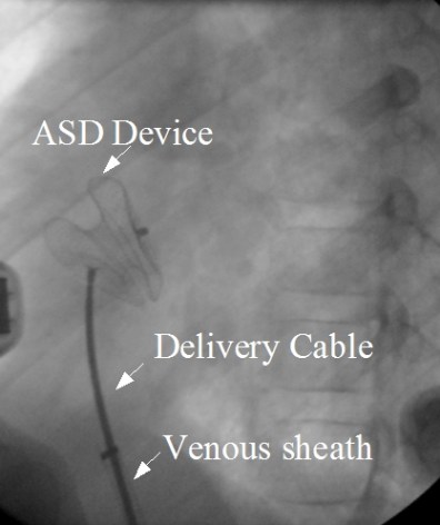 Atrial Septal Defect Asd All About Cardiovascular System And Disorders