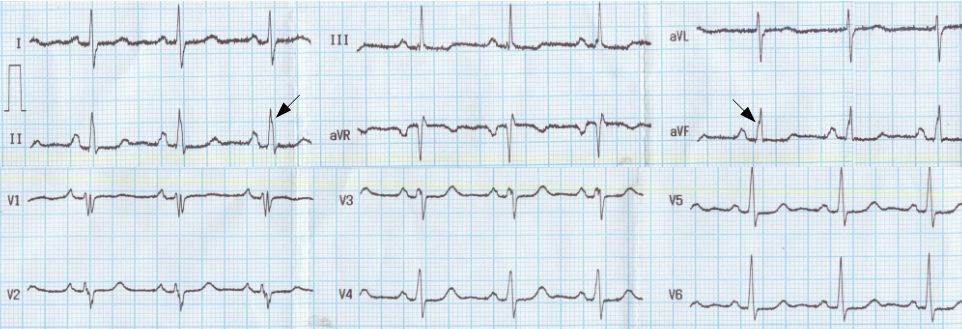 ECG showing crochetage sign in atrial septal defect