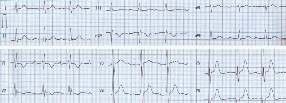 ECG after surgical closure of ASD