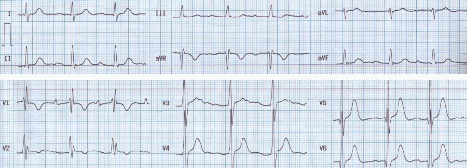 Crochetage pattern in the III and aV F leads