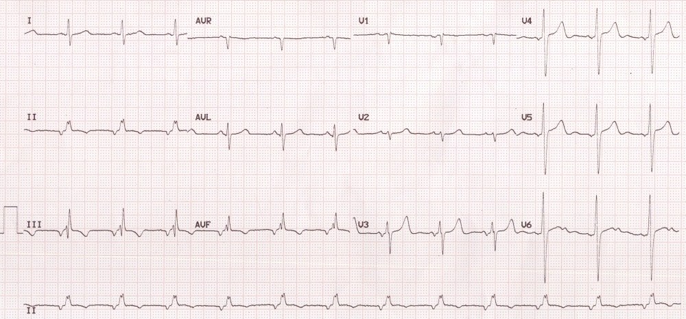 Low atrial rhythm