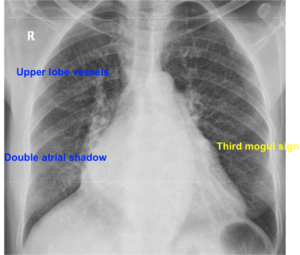 Double atrial shadow and prominent upper lobe vessels – All About ...