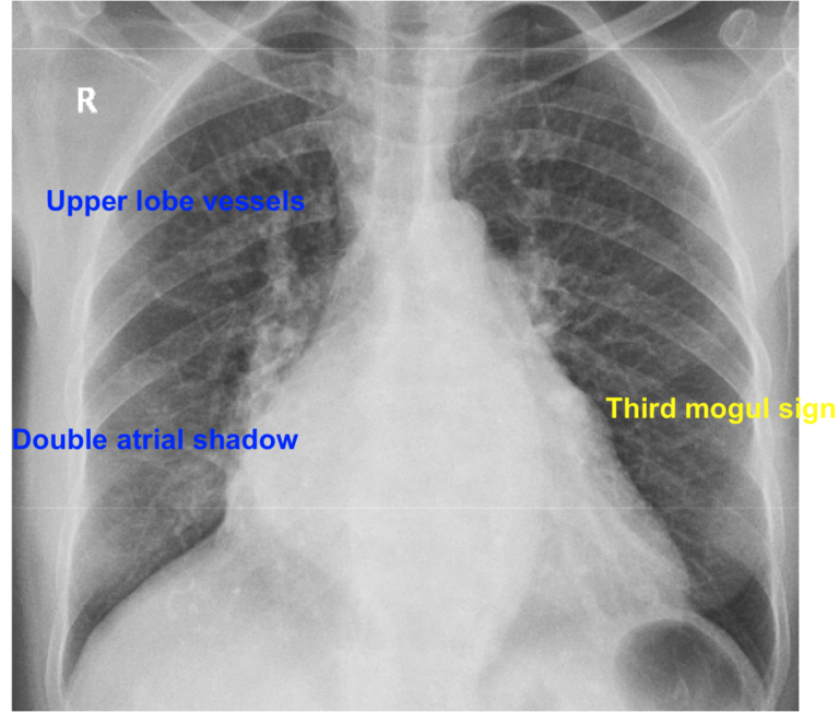 Double atrial shadow and prominent upper lobe vessels – All About ...