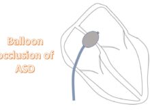 Balloon occlusion of ASD